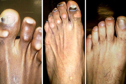 Football foot health: Your feet are vital to your success